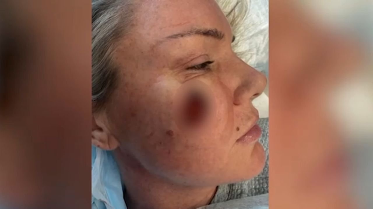 Chicago Woman's Routine Skin Check Turns Into Life-Changing Cancer Fight